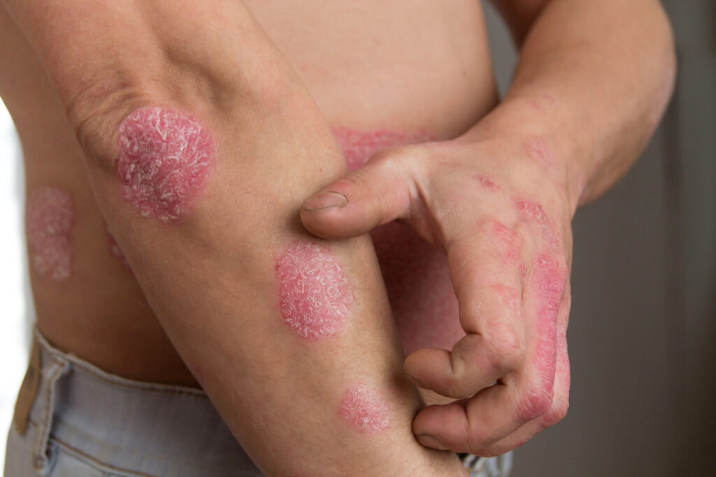 Is psoriasis a gut problem
