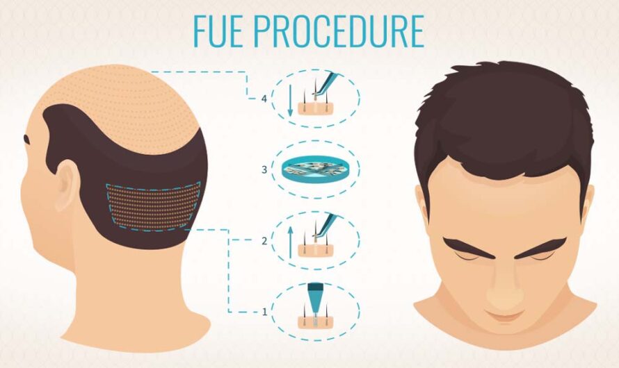 Break The Hair Loss Stigma With Fue Transplant